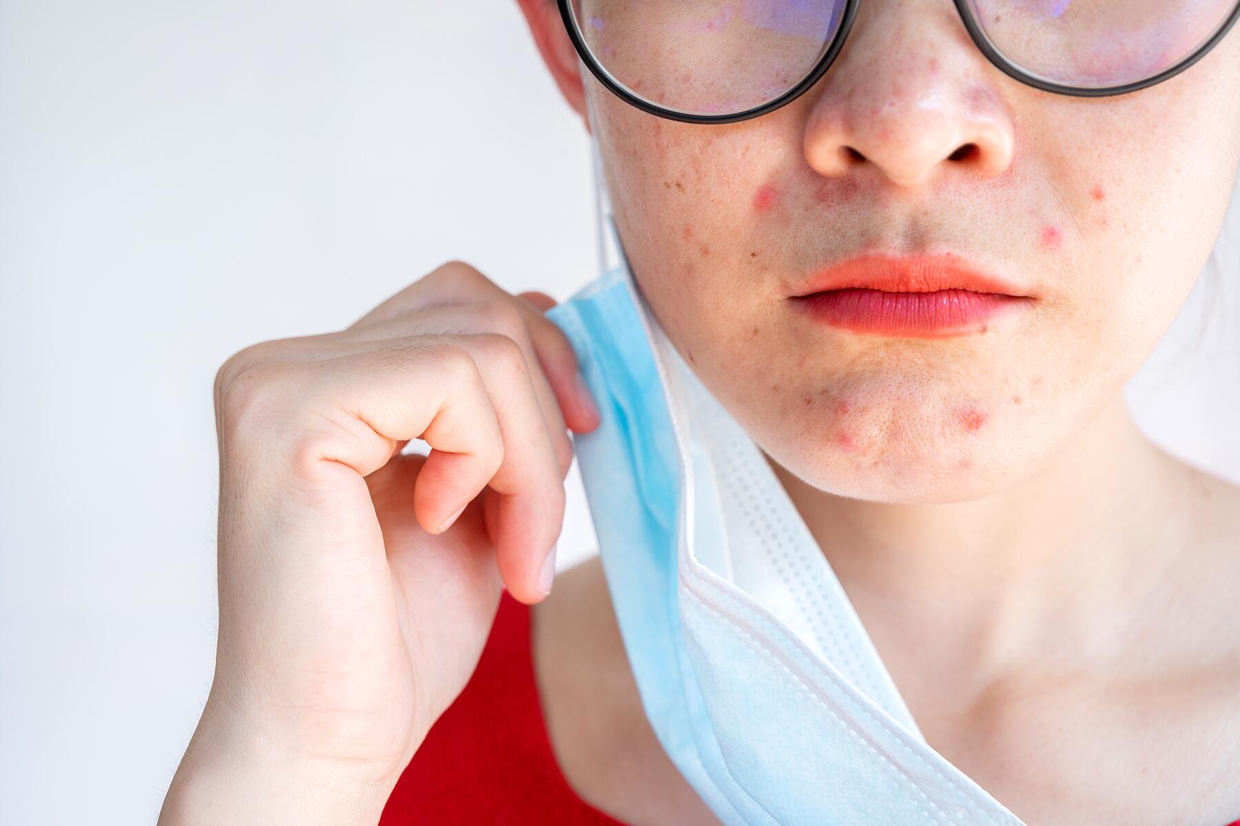 12_WordsInventedDuringPandemic__Maskne_shutterstock_1869464965