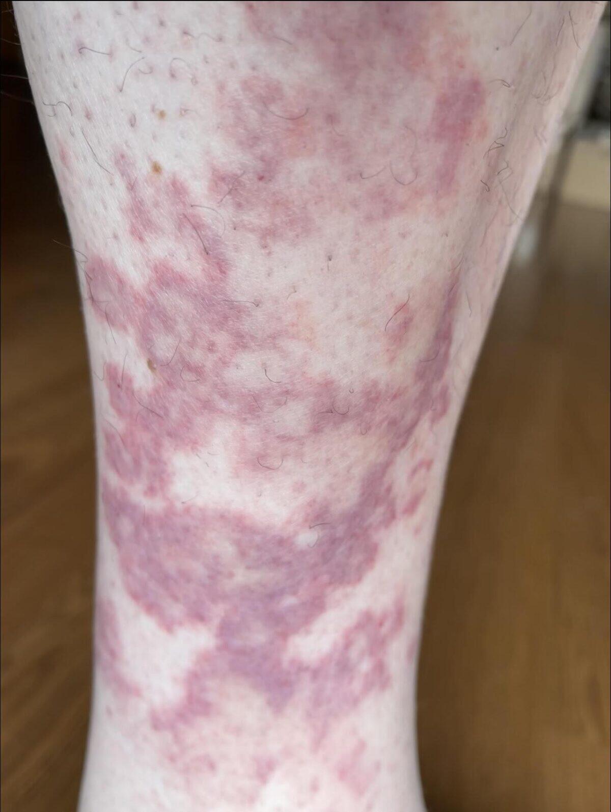 What Is Disney Rash and How Do You Prevent It?